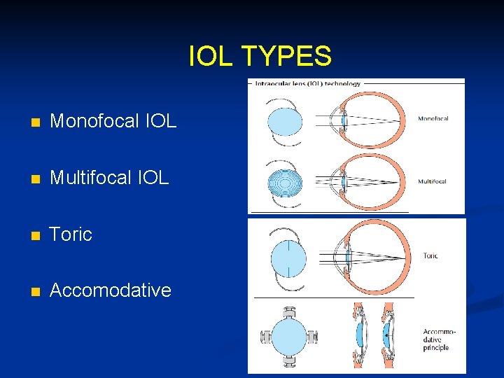 IOL TYPES n Monofocal IOL n Multifocal IOL n Toric n Accomodative 