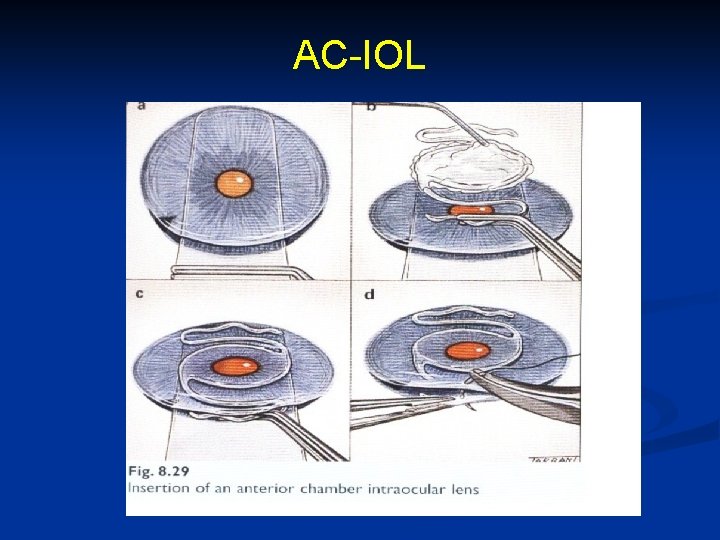 AC-IOL 