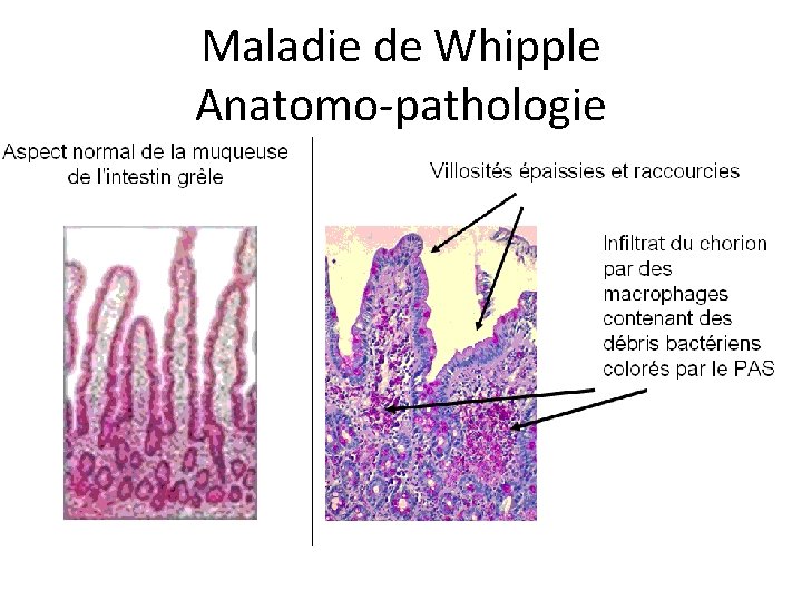 Maladie de Whipple Anatomo-pathologie 