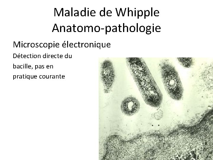 Maladie de Whipple Anatomo-pathologie Microscopie électronique Détection directe du bacille, pas en pratique courante