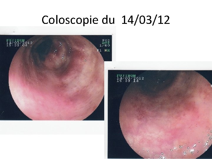 Coloscopie du 14/03/12 