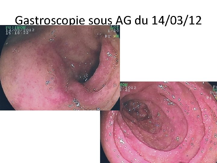 Gastroscopie sous AG du 14/03/12 