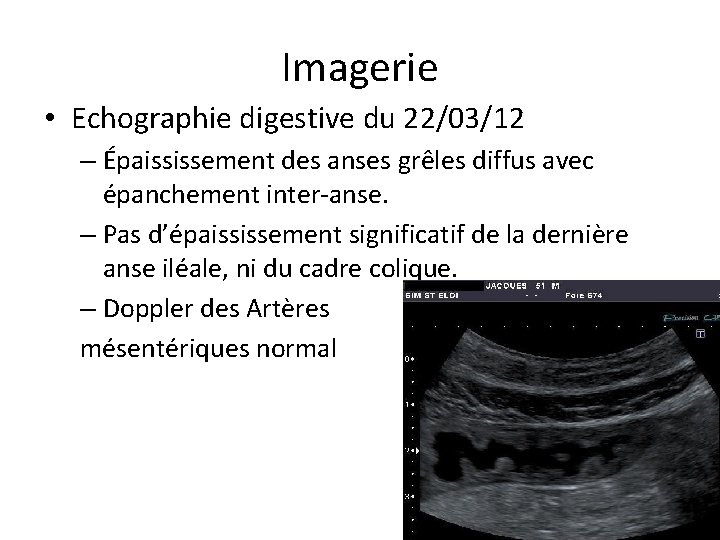 Imagerie • Echographie digestive du 22/03/12 – Épaississement des anses grêles diffus avec épanchement