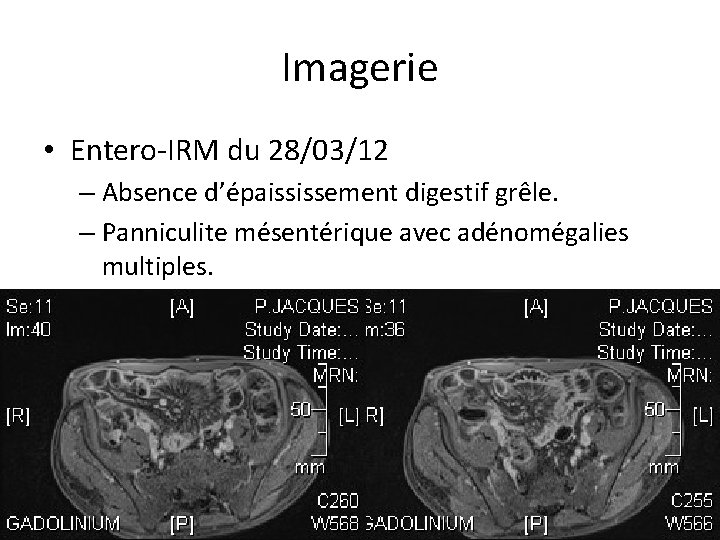 Imagerie • Entero-IRM du 28/03/12 – Absence d’épaississement digestif grêle. – Panniculite mésentérique avec