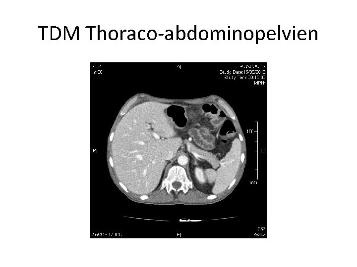 TDM Thoraco-abdominopelvien 