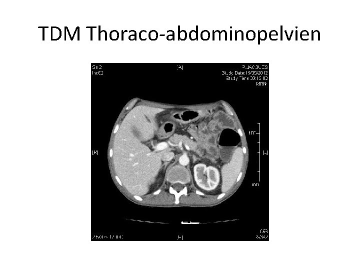 TDM Thoraco-abdominopelvien 