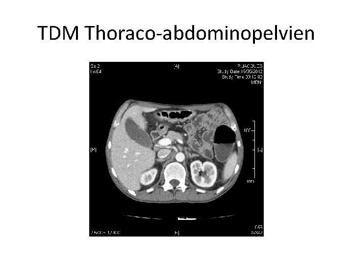 TDM Thoraco-abdominopelvien 