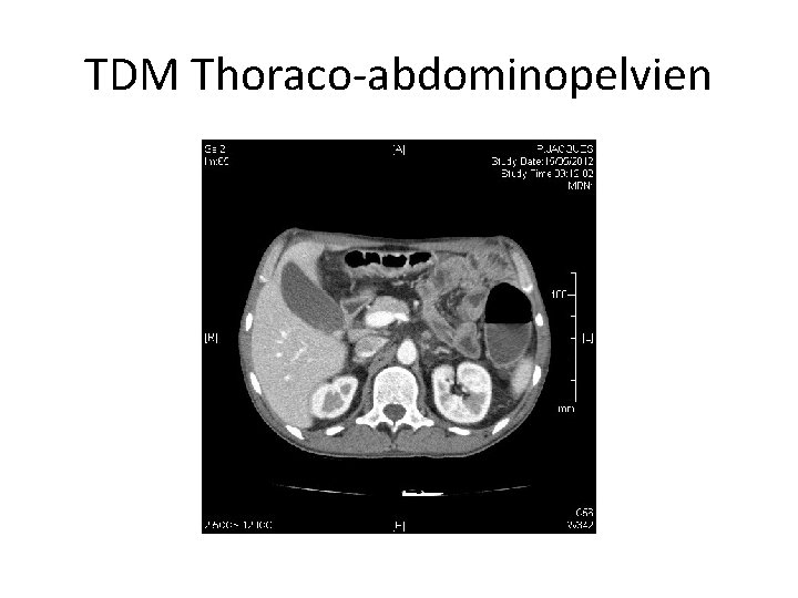 TDM Thoraco-abdominopelvien 