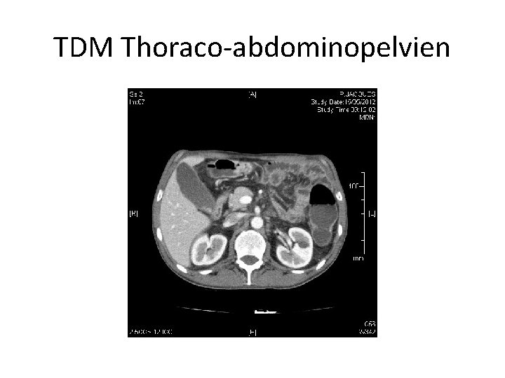 TDM Thoraco-abdominopelvien 