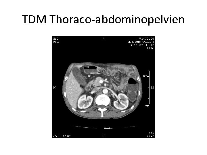 TDM Thoraco-abdominopelvien 