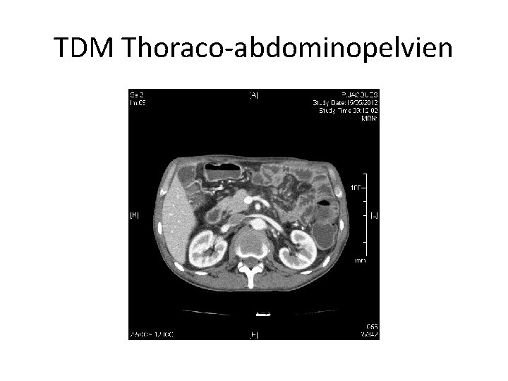 TDM Thoraco-abdominopelvien 
