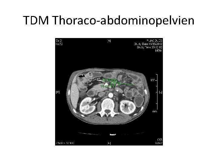 TDM Thoraco-abdominopelvien 