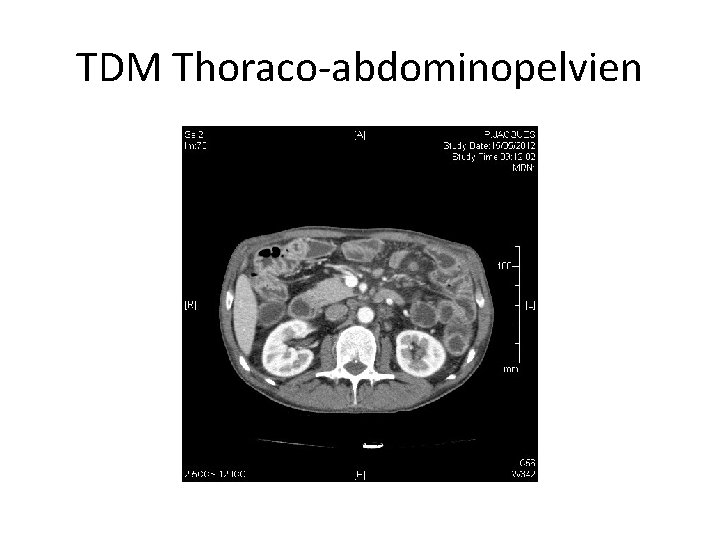TDM Thoraco-abdominopelvien 