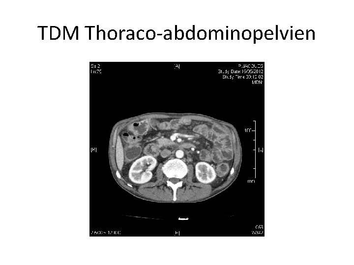 TDM Thoraco-abdominopelvien 