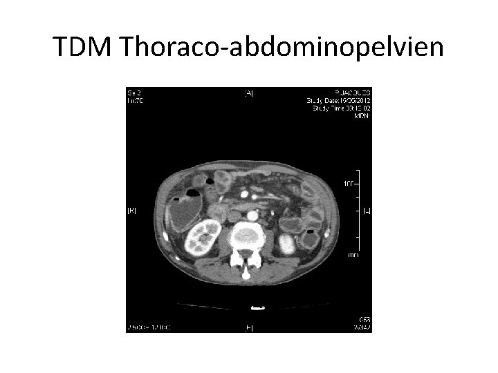 TDM Thoraco-abdominopelvien 