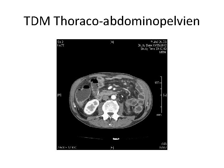 TDM Thoraco-abdominopelvien 