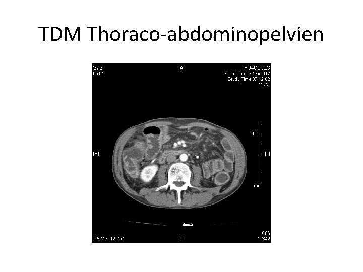 TDM Thoraco-abdominopelvien 