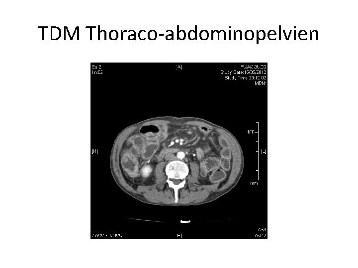 TDM Thoraco-abdominopelvien 