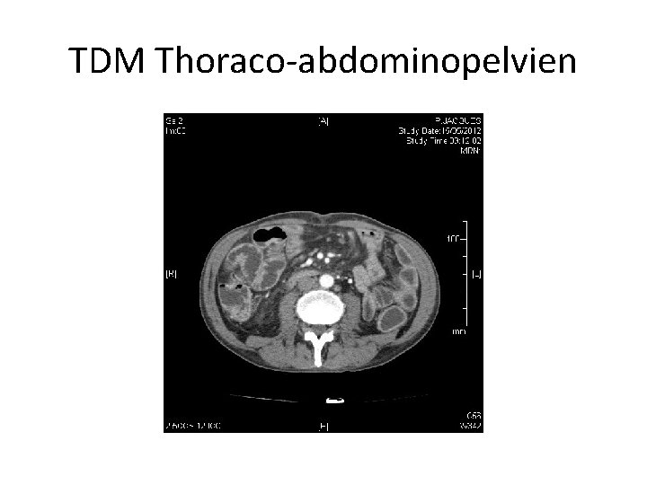 TDM Thoraco-abdominopelvien 