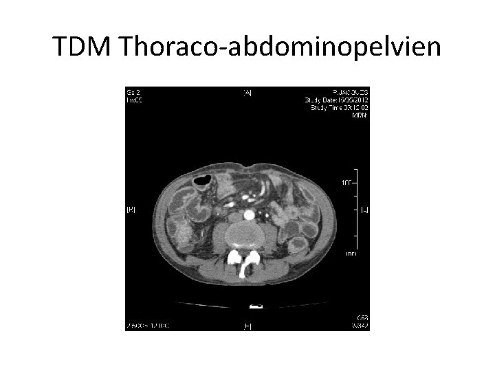 TDM Thoraco-abdominopelvien 