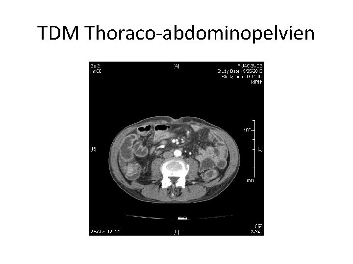 TDM Thoraco-abdominopelvien 