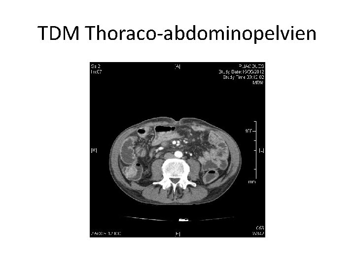 TDM Thoraco-abdominopelvien 