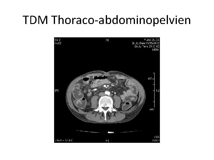 TDM Thoraco-abdominopelvien 