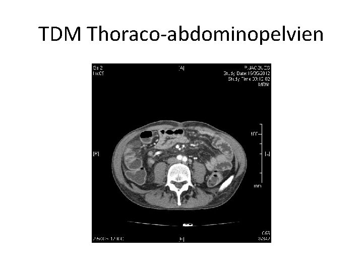 TDM Thoraco-abdominopelvien 