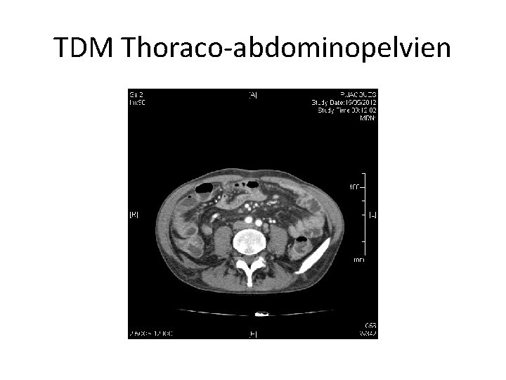 TDM Thoraco-abdominopelvien 