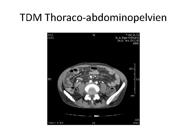 TDM Thoraco-abdominopelvien 