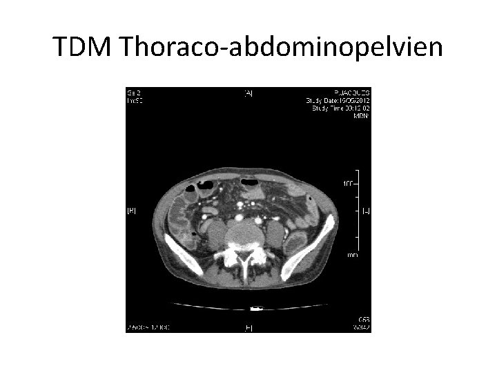 TDM Thoraco-abdominopelvien 