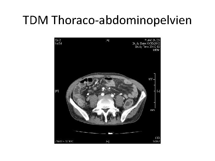 TDM Thoraco-abdominopelvien 