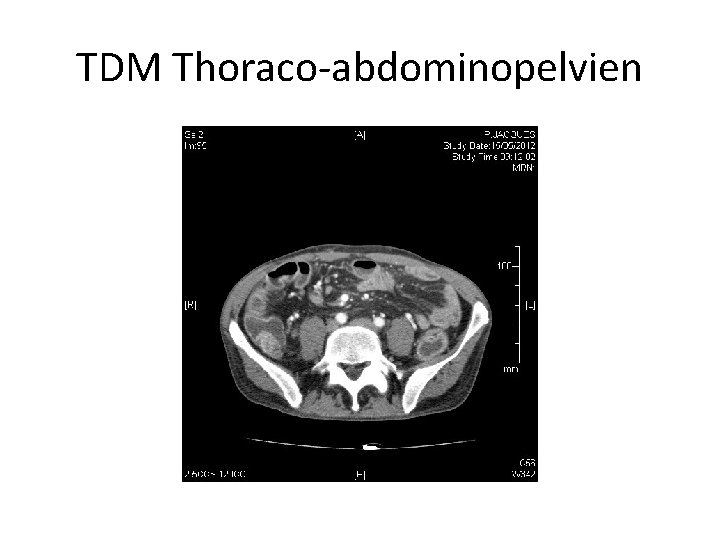 TDM Thoraco-abdominopelvien 