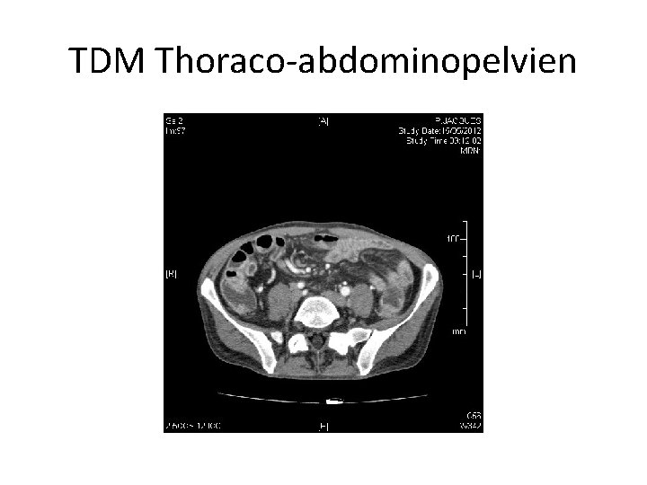 TDM Thoraco-abdominopelvien 