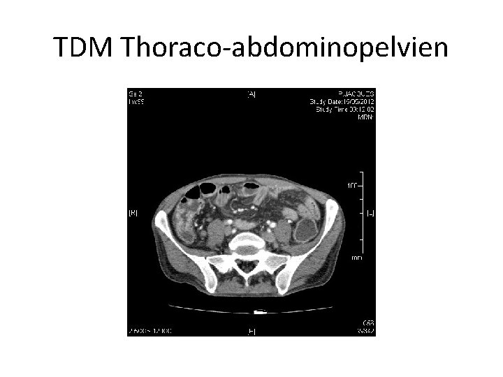 TDM Thoraco-abdominopelvien 