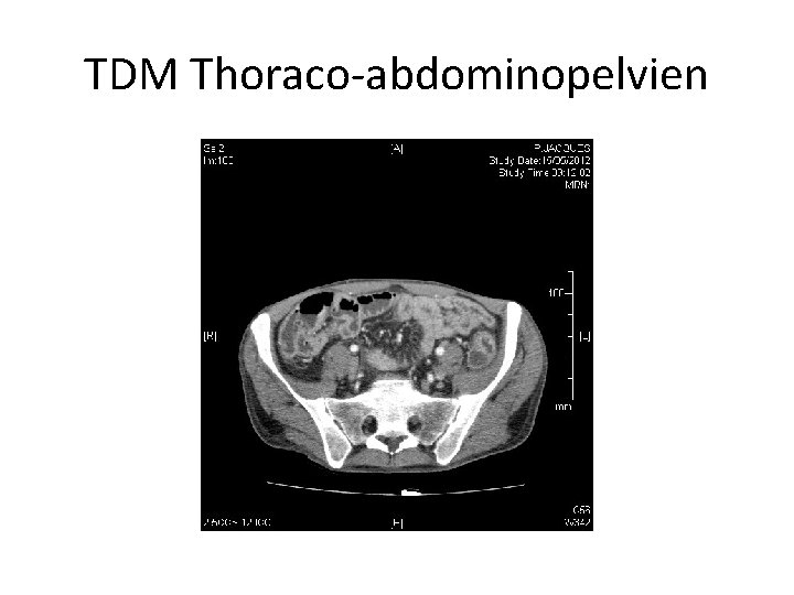 TDM Thoraco-abdominopelvien 