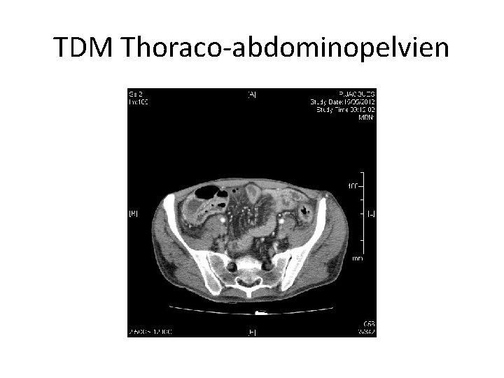 TDM Thoraco-abdominopelvien 