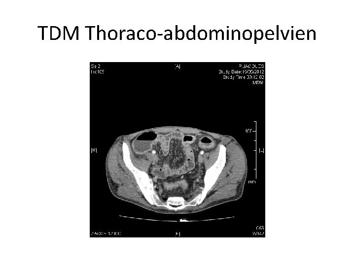 TDM Thoraco-abdominopelvien 