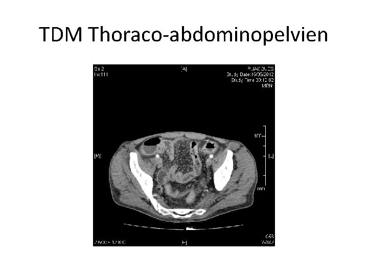 TDM Thoraco-abdominopelvien 
