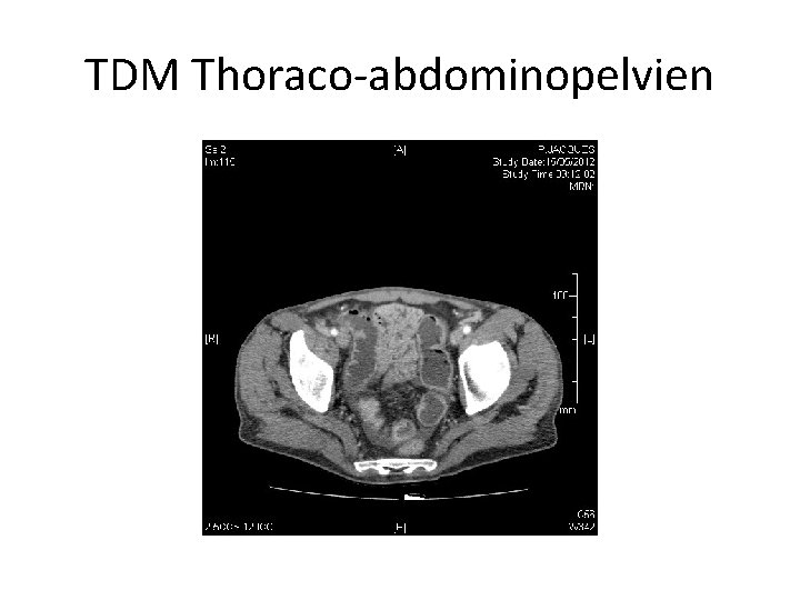 TDM Thoraco-abdominopelvien 