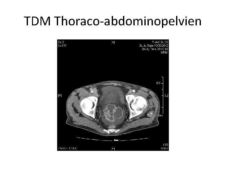 TDM Thoraco-abdominopelvien 