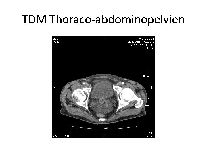 TDM Thoraco-abdominopelvien 