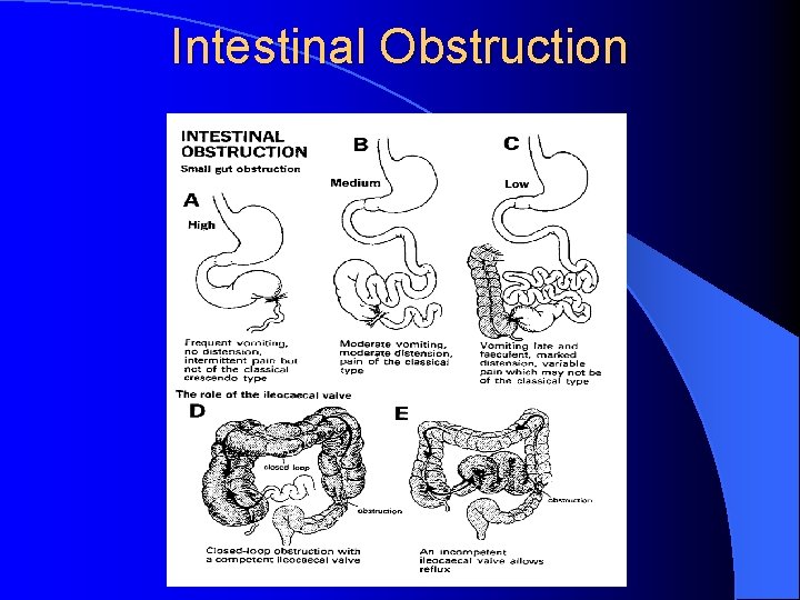 Intestinal Obstruction 