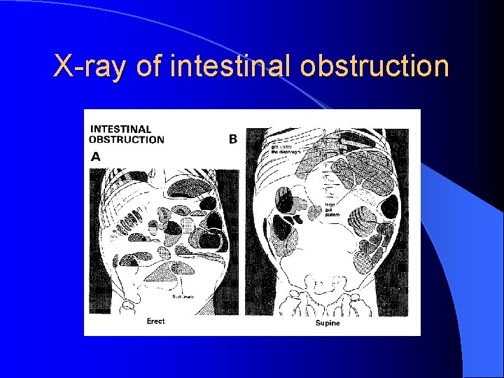 X-ray of intestinal obstruction 