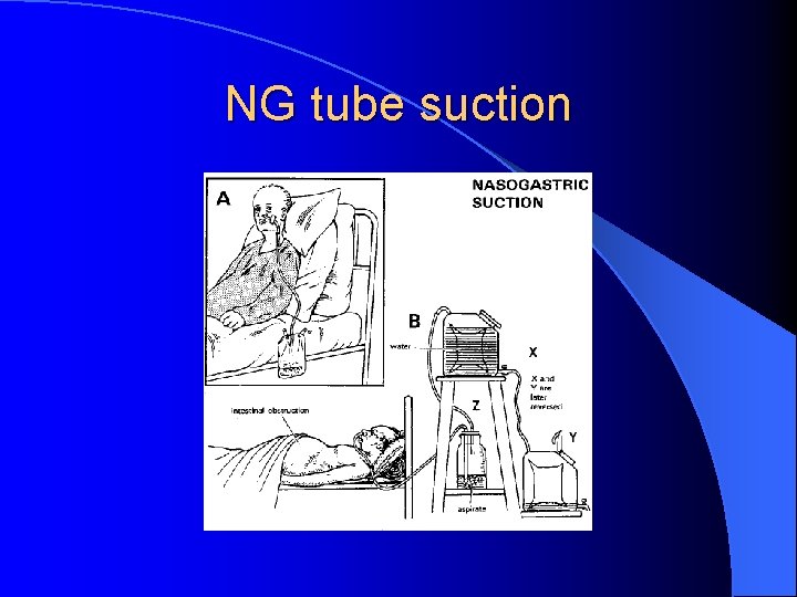 NG tube suction 
