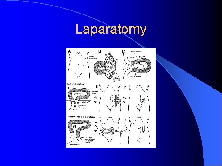 Laparatomy 
