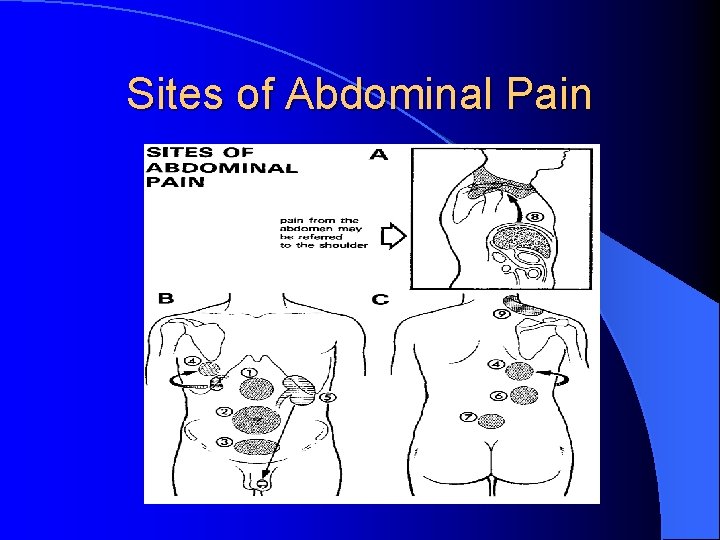 Sites of Abdominal Pain 