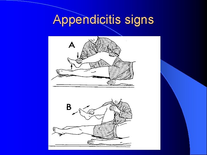 Appendicitis signs 
