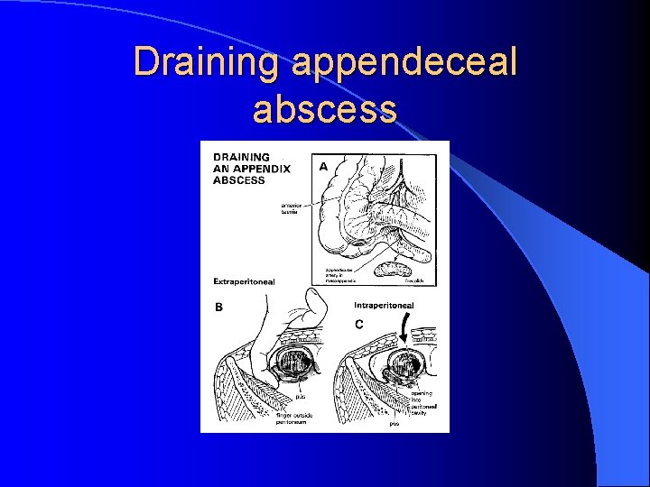 Draining appendeceal abscess 