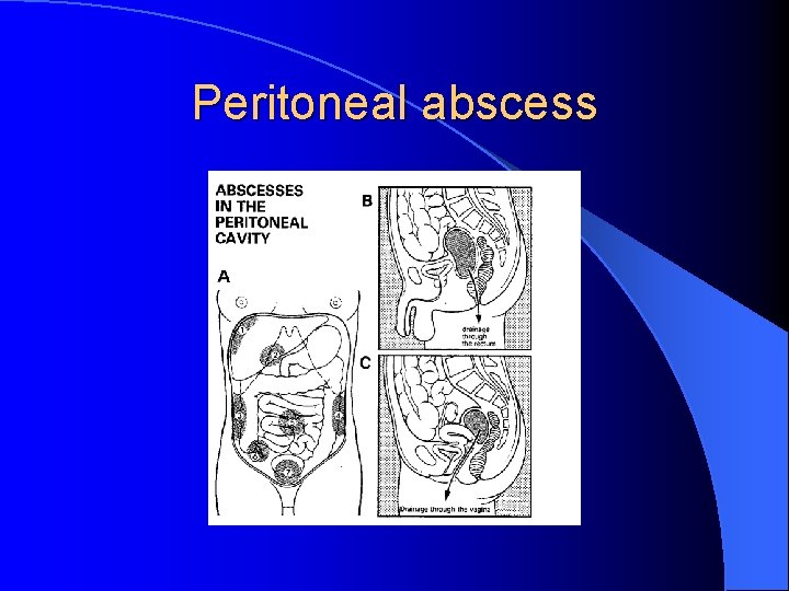 Peritoneal abscess 